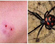 Укус павука відправив українця на лікарняне ліжко: "отрута в 15 разів сильніше, ніж у гримучої змії"