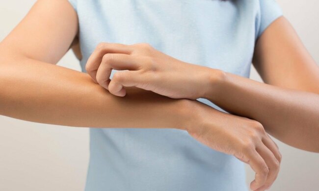 Комар перетворив життя дніпрянки на жах: “під шкірою жив паразит”