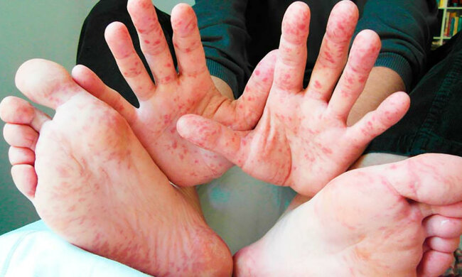 корь болезнь