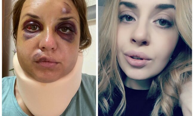 "Боїться залишатися один": журналістка, яку побили в потязі, розповіла про психічний стан сина