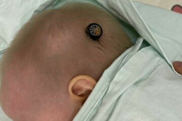 "Невдало впала": в голову дев'ятимісячного малятка вп'ялася частина іграшки, її життя опинилося в небезпеці