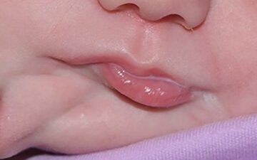 Дівчинка народилася з двома ротами: фото до і після операції