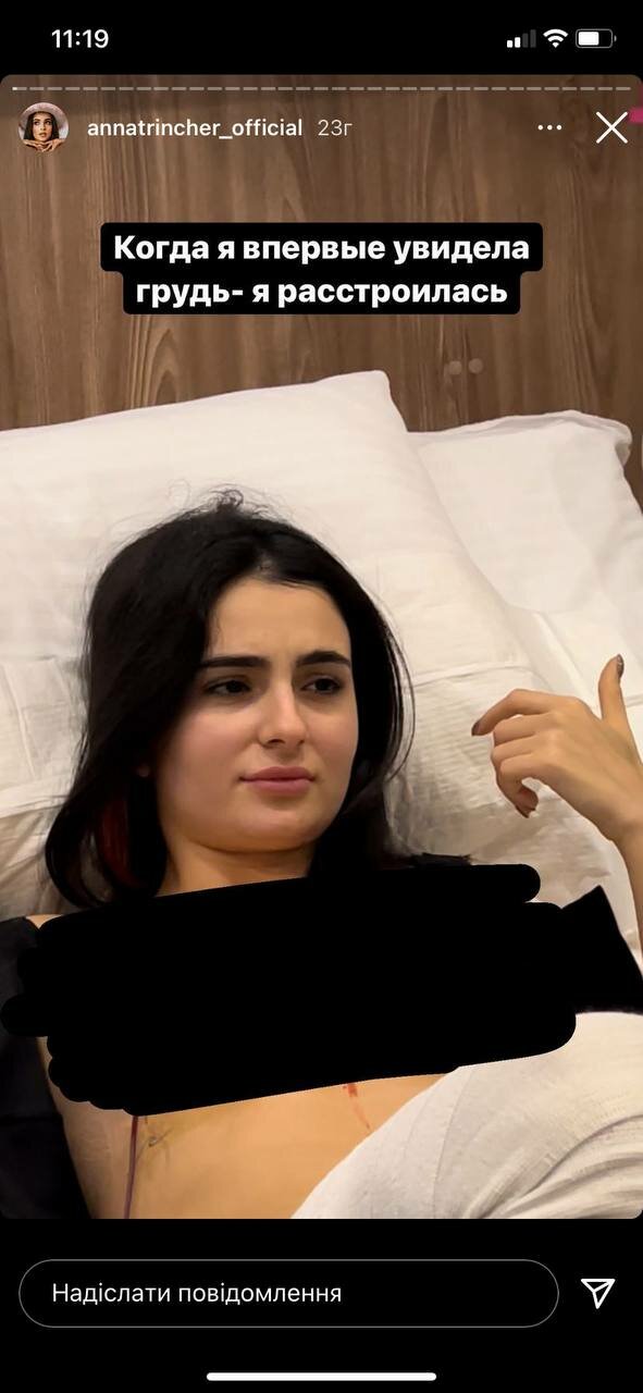 Анна Тринчер, которая перенесла тяжелую пластическую