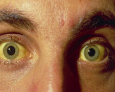 глаза гепатит