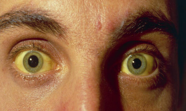 глаза гепатит