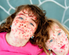 Child girls mischief pretending lipstick measles