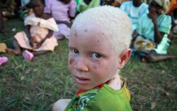 танзания альбинос