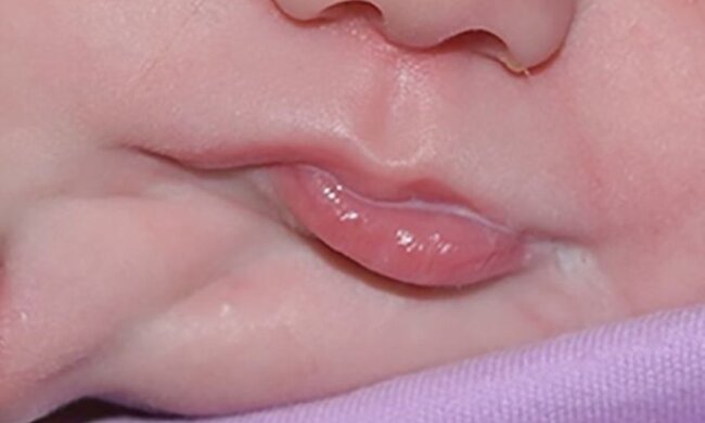 Дівчинка народилася з двома ротами: фото до і після операції