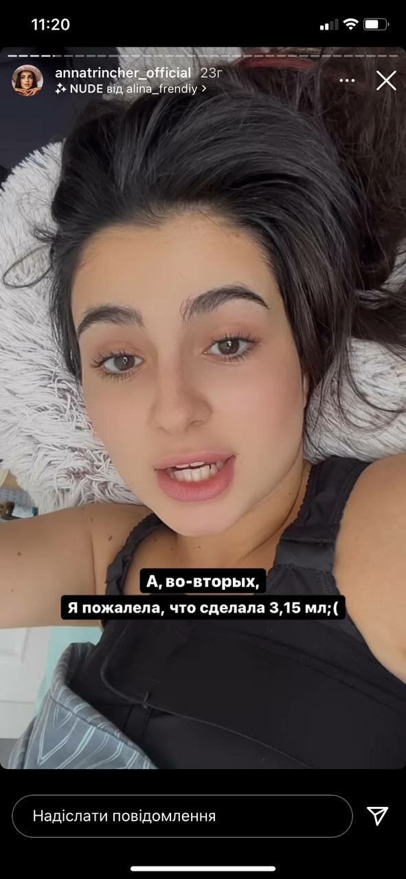 Анна Тринчер, которая перенесла тяжелую пластическую