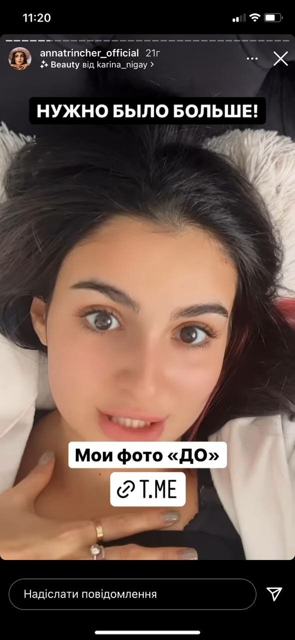 Анна Тринчер, которая перенесла тяжелую пластическую