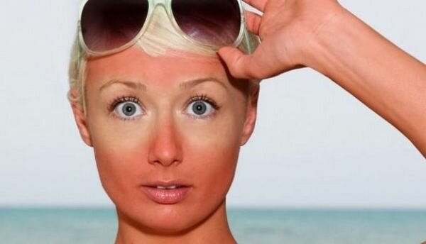 солнечный ожог, море, отпуск