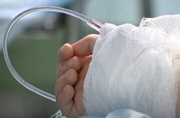 "Необхідно рятувати руки": маленька українка пригнула в окріп, за життя малятка борються лікарі