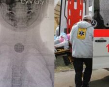 5-летняя девочка попала в реанимацию с батарейкой в горле: детали ЧП на Львовщине