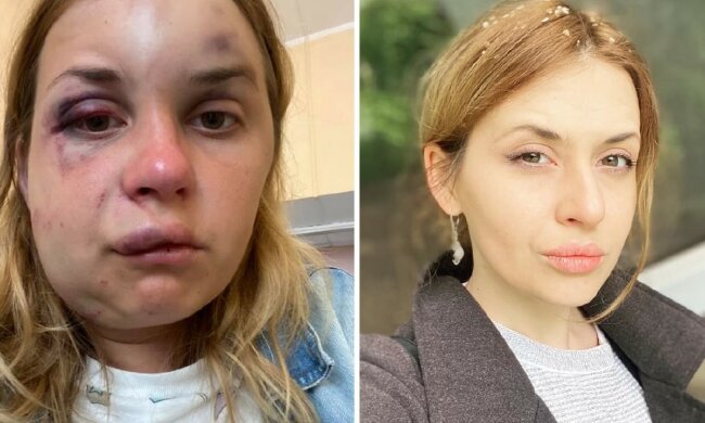 Журналістці, яку побили в поїзді, стало гірше: з'явилися нові фото