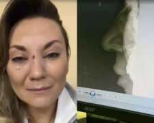 Біда з дружиною продюсера "Квартал 95", Ганна Саліванчук розбила обличчя та зламала носа: кадри з лікарні