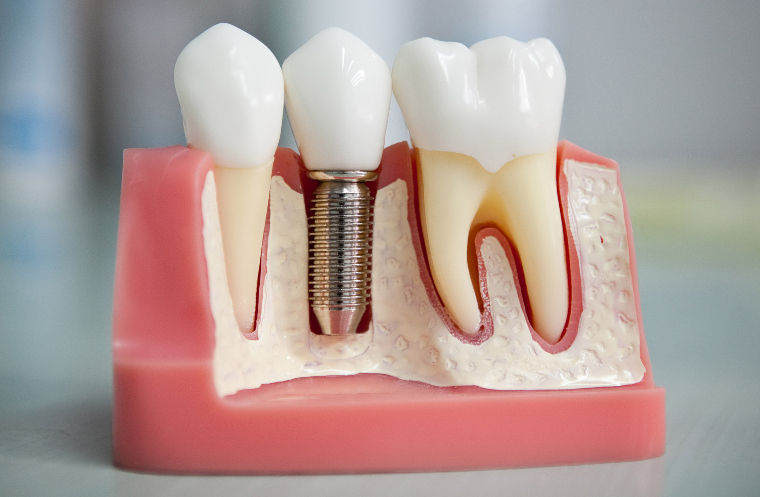 Имплантация зубов: ключевые методы, основные плюсы